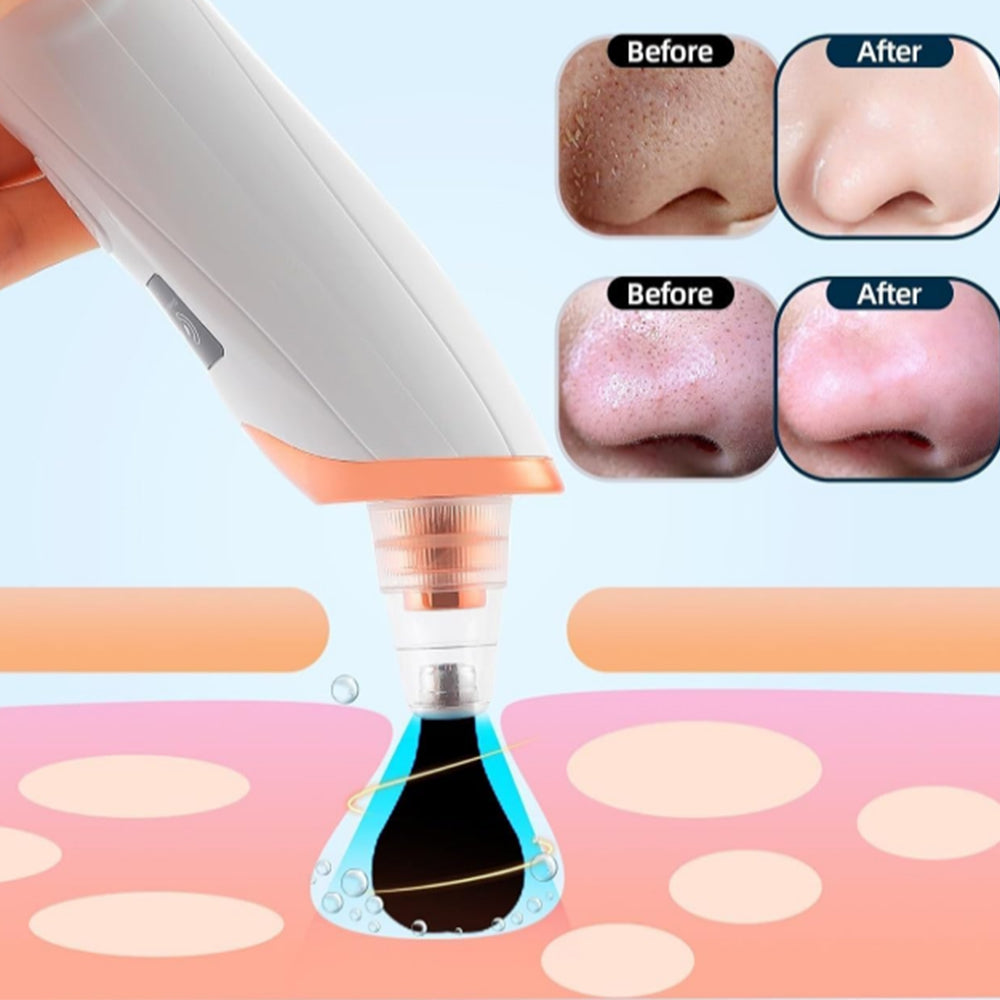 Vacuum Blackhead Remover Facial Skin Pore Acne Pimple with 5 Suction Probes 4 Acne Needles