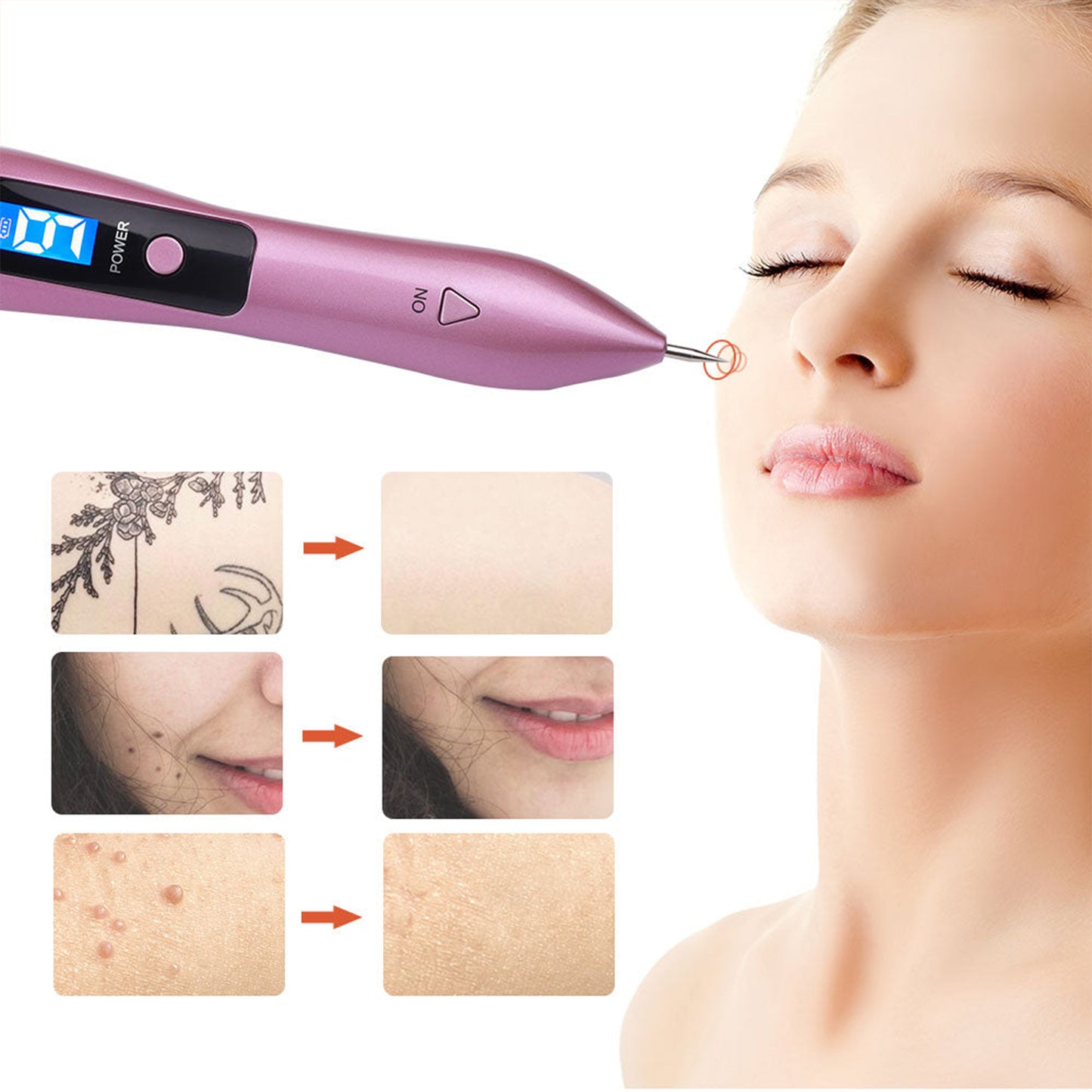 Rechargeable Nine Level Adjustable Skin Spot Removal Pen LCD Plasma Pen