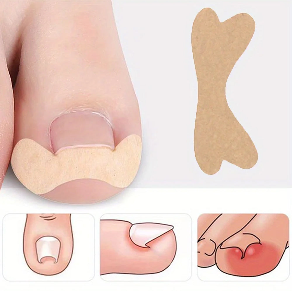 60Pcs Ingrown Toenail Correction Stickers