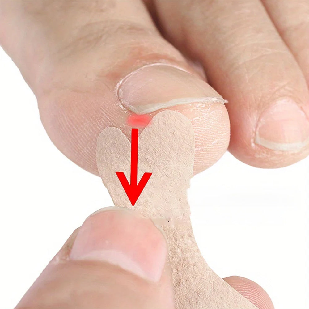 60Pcs Ingrown Toenail Correction Stickers