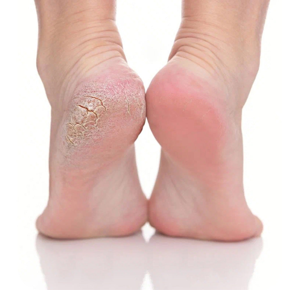 Electric Digital Foot Callus Remover Adjustable Speed Rechargeable Foot Sander For Dead Skin