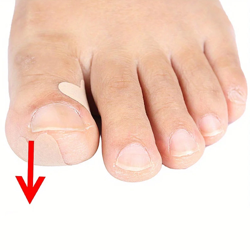 120Pcs Ingrown Toenail Correction Stickers