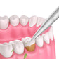 Electric Dental Calculus Removal Teeth Cleaning Kit With LED Light